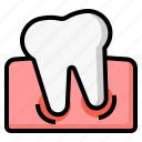 wisdom tooth, dental, dentist, dentistry, oral care