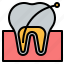 tooth, root, canal, odontology, dental, teeth, dentist 