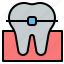 braces, orthodontic, dentistry, dental, teeth, tooth, dentist 