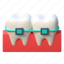 tooth, alignment, braces, dental, illustration, 3d cartoon, isolated, healthcare, teeth, clean 