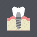 dental, dentist, health, implant, medical, molar, tooth 