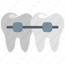 braces, alignment, dentist, tooths