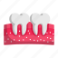 pulp cavity, teeth, tooth, dental, dentistry, care 