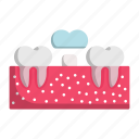 artificial, teeth, tooth, dental, cover, crown