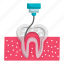 teeth, tooth, root canal, surgery, treatment, injection, endodontic therapy 