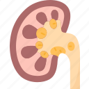 kidney, stone, disease, infection, health