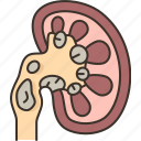 kidney, stone, diagnosis, disease, problem