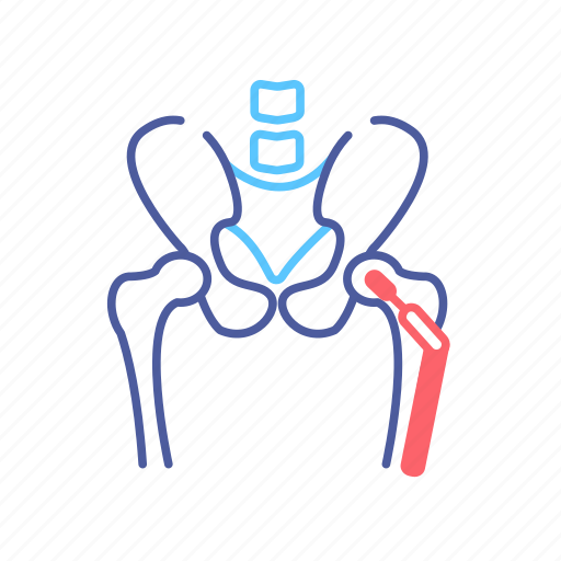 Anatomy, bone, hip replacement, human, implant, orthopedics, skeleton icon - Download on Iconfinder